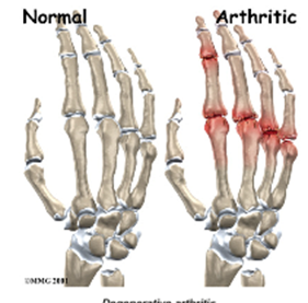 ARTHRITIS OF THE FINGER JOINTS – The Centre for Musculoskeletal Medicine