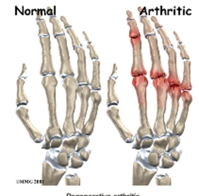 Finger joints Arthritis