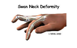 Swan Neck Deformity