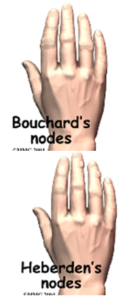 bouchards-nodes-heberden-nodes