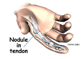 nodule in tendon